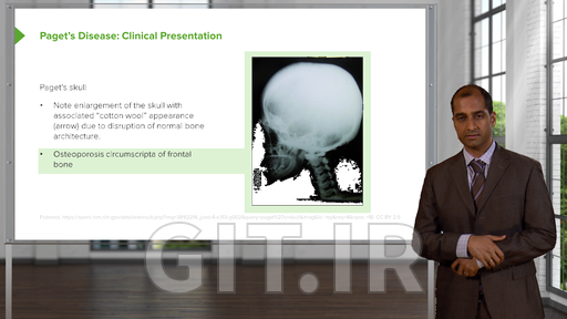 Bone Disease