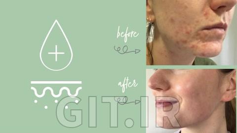 Adult Acne: Skincare for Clear Skin