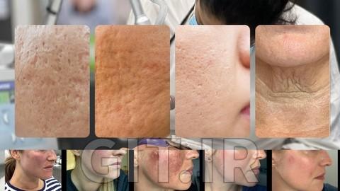 CO2 Fractional Laser for Acne Scars – Aesthetic Training