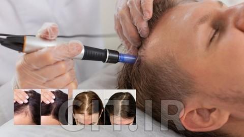 Hair Restoration Training: PRP + Microneedling (Dr. Pen)