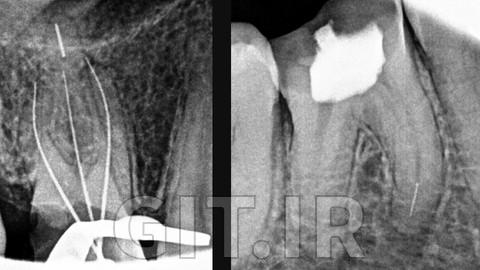 Management of Separated Endodontic Instrument