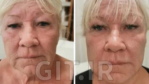 Ultimate Anti-Aging Microneedling Masterclass